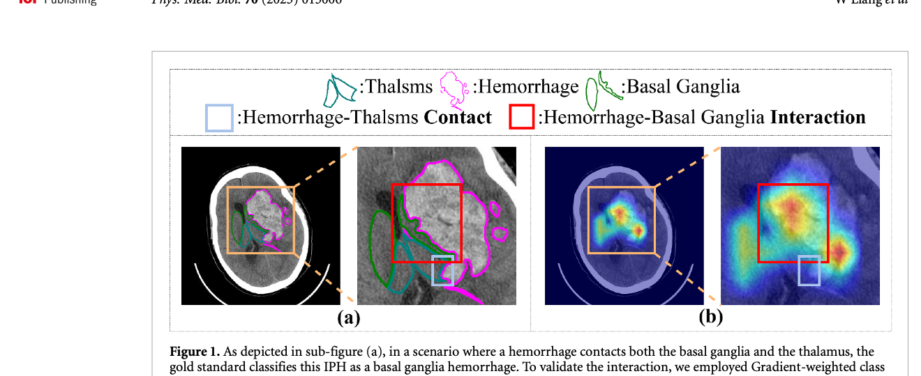 Pairwise hemorrhage-brain region interaction